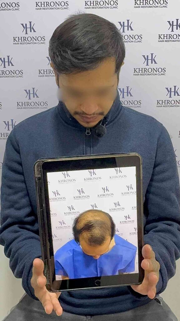 Antes y después de trasplante capilar realizado en Khronos Hair Restoration Clinic mostrando recuperación de línea frontal y aumento de densidad capilar.