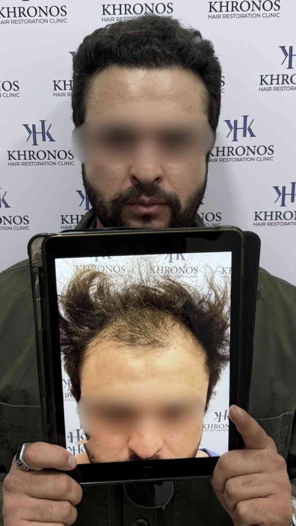 Antes y después de trasplante capilar realizado en Khronos Hair Restoration Clinic mostrando recuperación de línea frontal y aumento de densidad capilar.