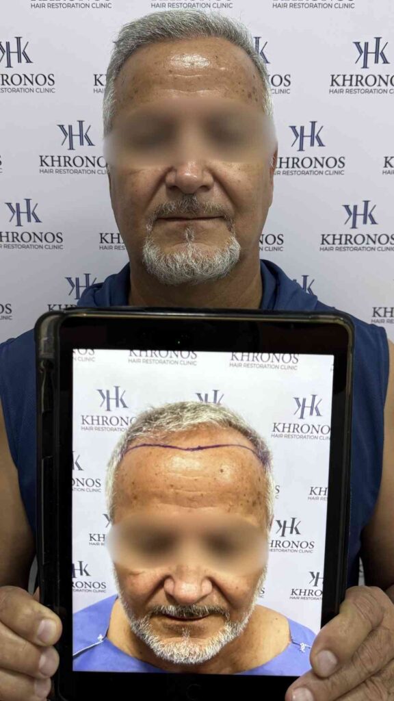 Antes y después de trasplante capilar realizado en Khronos Hair Restoration Clinic mostrando recuperación de línea frontal y aumento de densidad capilar.