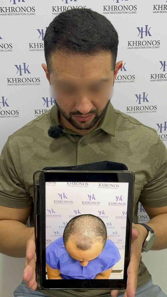 Antes y después de trasplante capilar realizado en Khronos Hair Restoration Clinic mostrando recuperación de línea frontal y aumento de densidad capilar.