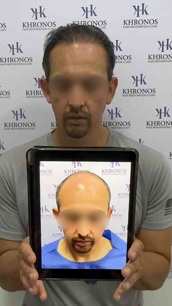 Antes y después de trasplante capilar realizado en Khronos Hair Restoration Clinic mostrando recuperación de línea frontal y aumento de densidad capilar.